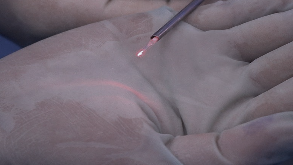 Tratamento de cisto pilonidal com Laser de Diiodo