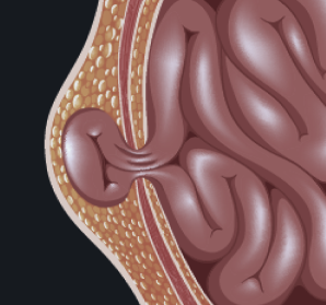 Cirurgia de Hérnias