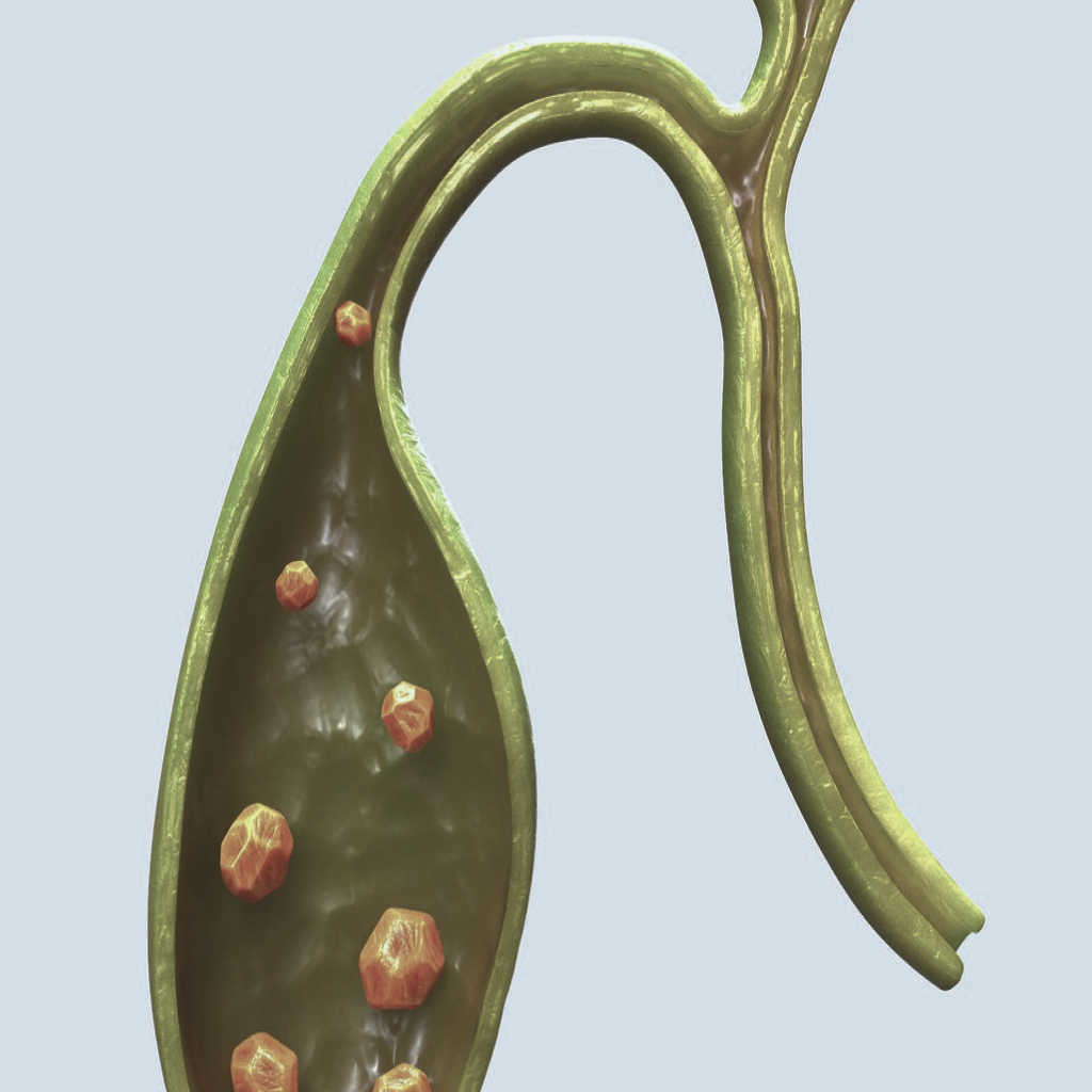 Cirurgia de Vesícula Biliar